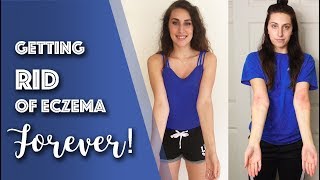 How I CURED my Eczema in 6 Months! 5 Diet Tips