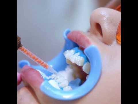 Implantes del Norte - Tratamientos Odontológicos (Blanqueamiento Dental)