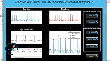 Upgraded - Arrhythmia Recognition and Classification Using KNN - Digital Signal Processing | MATLAB