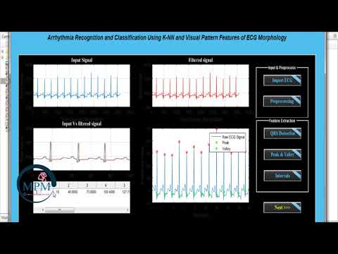 Upgraded - Arrhythmia Recognition and Classification Using KNN - Digital Signal Processing | MATLAB