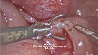 Laparoscopic Assisted Transanal Pull Through (TAPT) for Hirschsprung disease In Neonate