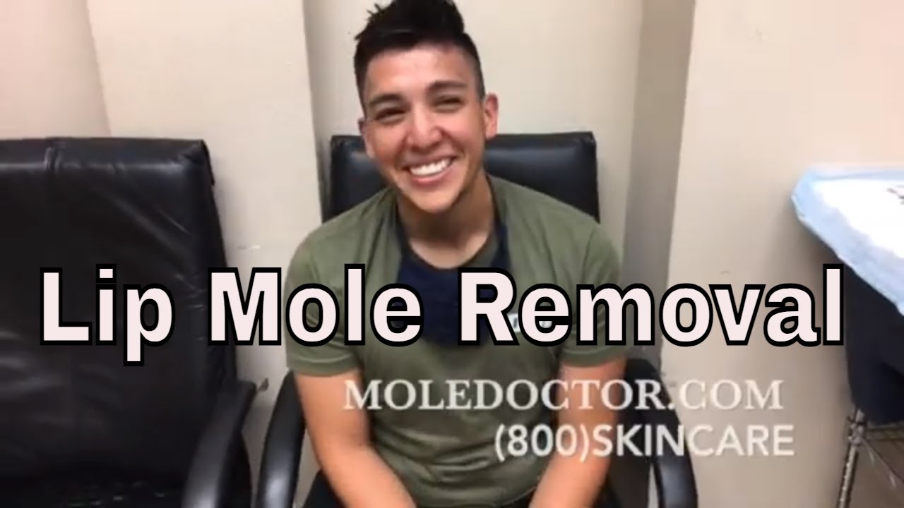 Lip mole removal YouTube