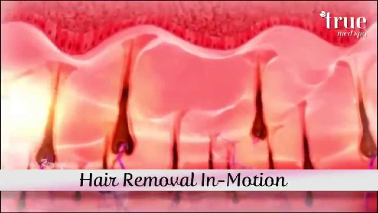 Pain Free Permanent Laser Hair Removal Scottsdale, AZ YouTube