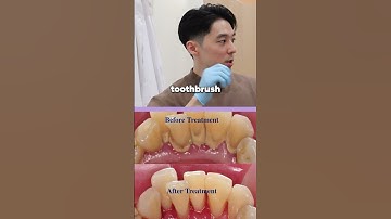 Thumbnail of What happens if you don't floss correctly? [Common dental myths]