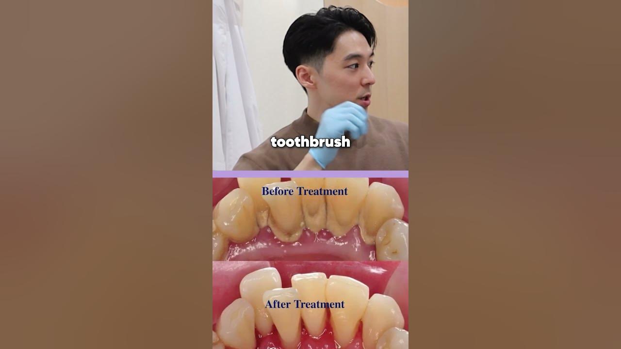 What happens if you don't floss correctly? [Common dental myths]