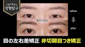 目の左右差 Youtube 目の左右差 Youtube