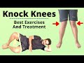 Knock Knees Treatment, Knock Knees Correction Exercises | Genu Valgum | Knock Knee Pain Exercises