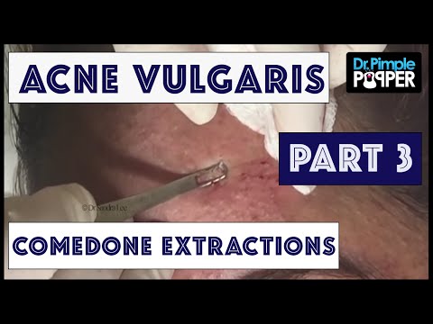 Extractions Of TNTC Whiteheads: Session One, Part 3 Of 3