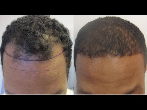 does finasteride 5mg regrow hair