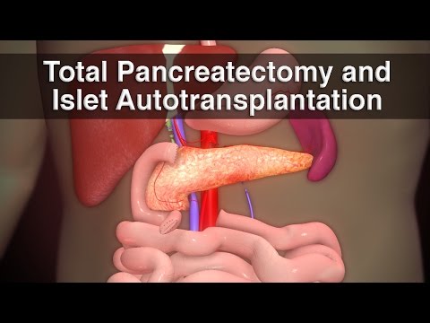 What is TPIAT? | Medical Animation | Cincinnati Children&rsquo;s