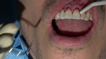Connective Tissue Graft for Gingival Recession (Tunnel Technique)