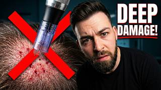 The Microneedling Depth That Wrecks Your Hair