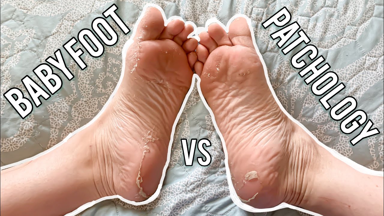 Baby Foot Vs Patchology Foot Peels Review Satisfying Foot Peels Not Sponsored Youtube