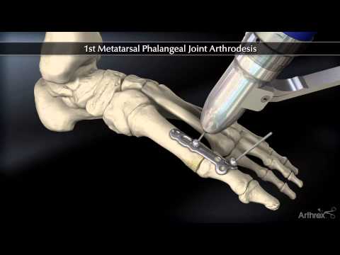 Vídeo: On és la primera articulació tarsometatarsiana?