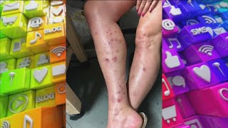 What is Causing Woman’s Gaping Leg Wounds?