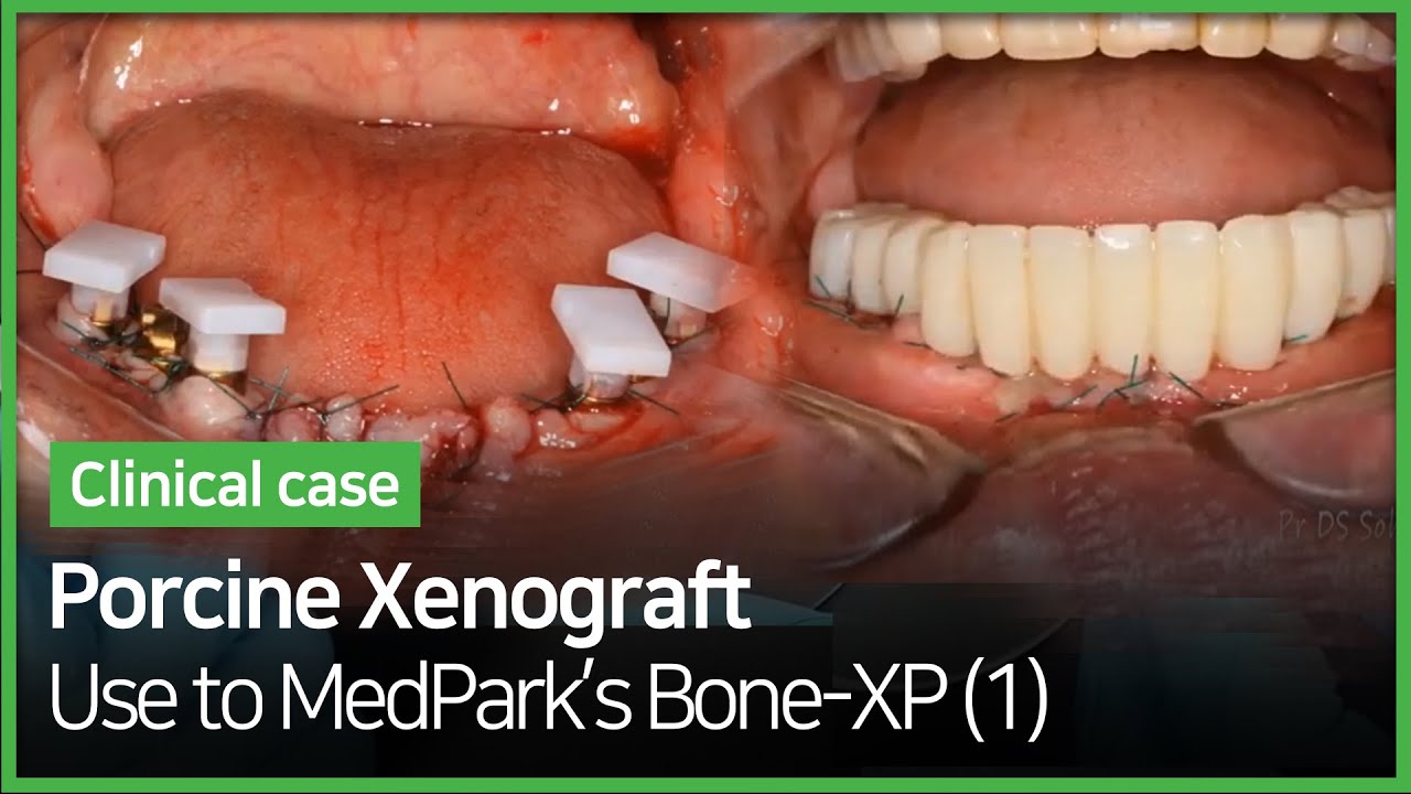 no1.MedPark_BoneXP (Porcine Xenograft) YouTube