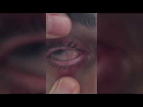 Graphic: Ontario man shows eye blinded by water-borne parasite