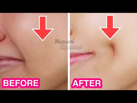 How To Get Dimples Fast & Naturally! Simple Facial Exercises to get Dimples without Surgery