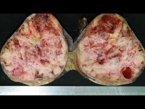 Video: Perbezaan Antara Teratoma Dan Seminoma