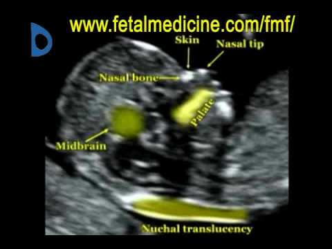 Fetal Medicine Foundation - Nuchal translucency