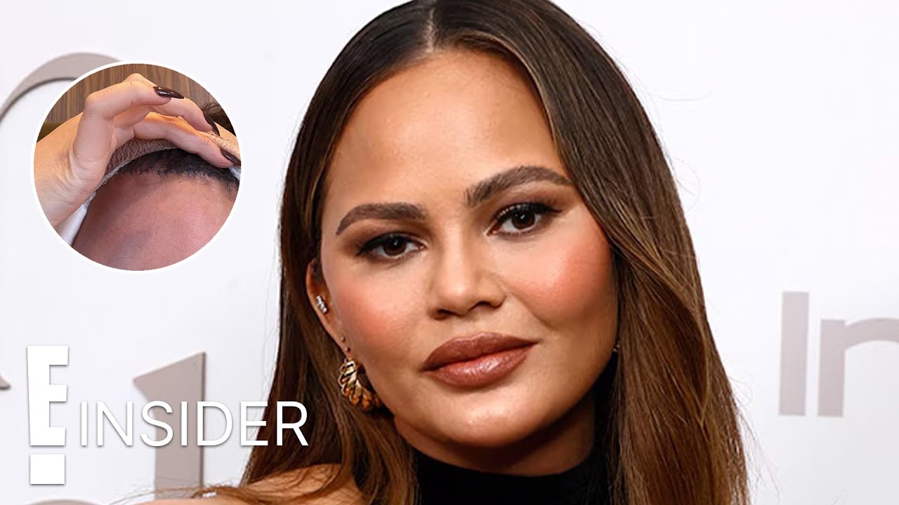 Chrissy Teigen Reveals Photo From Hairline Lowering Procedure E