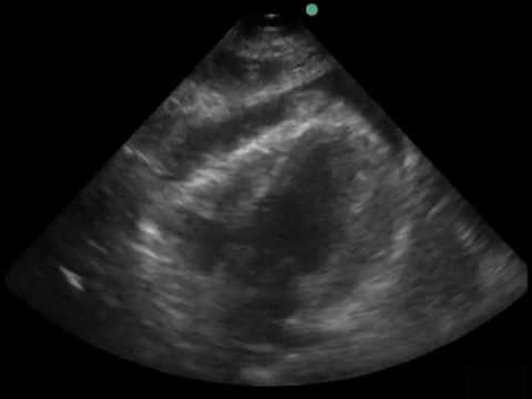 sonosite m turbo usado Heart Supxiphoid Moderate Pericardial Effusion