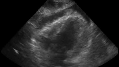 Heart Supxiphoid Moderate Pericardial Effusion