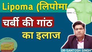 What is LIPOMA? Cause & Treament | Lipoma (Charbi Ki Ganth) Ka ilaj..