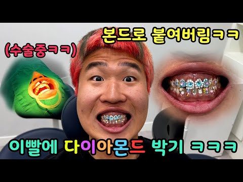 이빨 노란친구 이빨 빛나게 강력본드 로 다이아몬드 붙이기 ㅋㅋㅋ 