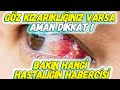 GÖZ KIZARIKLIĞINIZ VARSA, Aman Dikkat ! - BAKIN HANGİ HASTALIĞIN HABERCİSİ