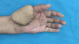 Management Of Crush Hand Injury.