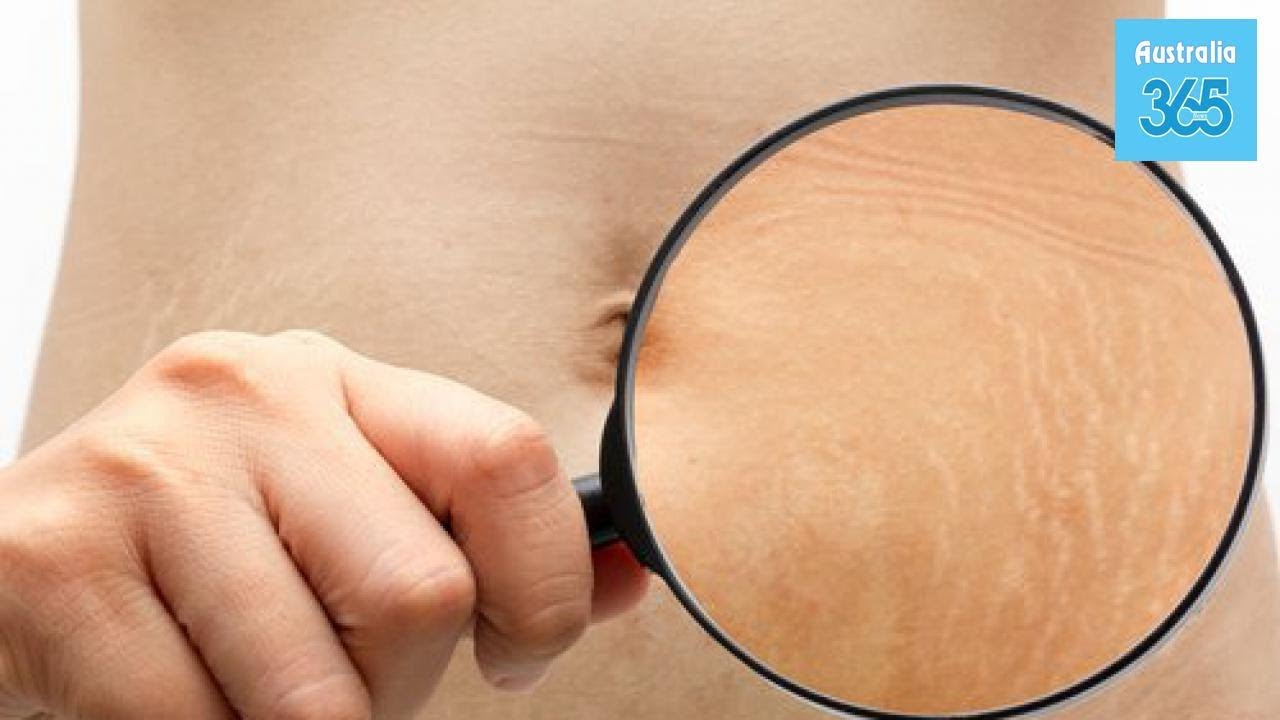 6 Tricks to Improve the Appearance of Stretch Marks - Australia 365