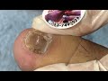 Ep_6588 Foot nails skin removal 👣 รู้สึกตึง ๆ เหมือนมีอะไรอยู่ข้างเล็บ 😄 (clip from Thailand)