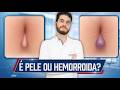 Plicoma ou hemorroida externa: Saiba a diferença real | Dr. Marcelo Werneck