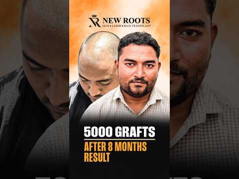 Hair Transplant Results in Nashik | 5000 Grafts | Marathi #hairtransplant #marathi #shorts
