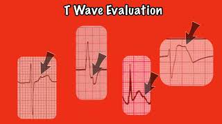 T Wave Evaluation: Step 6 to the 8 Step Method (EKG Rhythm Interpretation part 6.6)