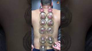 Fire Cupping Therapy for Back Pain | Muscle Recovery