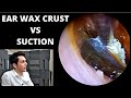 Encrusted Ear Wax VS Suction