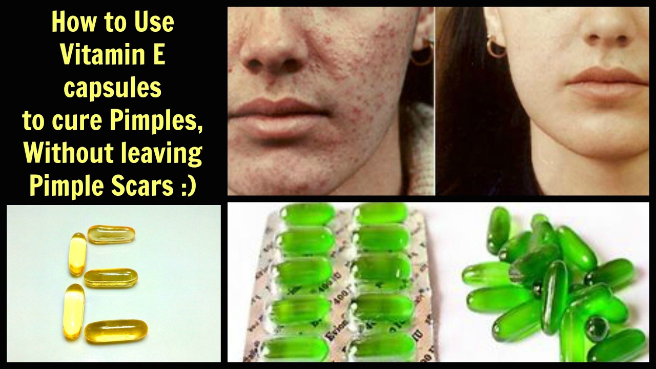 How To Use Vitamin E Capsules To Cure Pimples Without