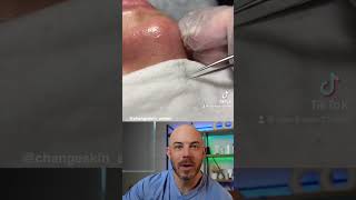 Dermatologist reacts to super satisfying clogged pore removal! #cloggedpores #dermreacts