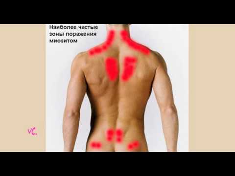 #Миозит. Не дай боли сесть на шею.