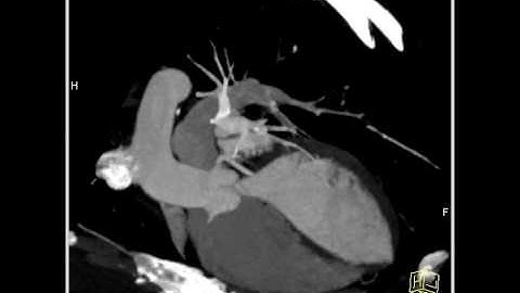 Vascular:Normal coronary MIP:Maximum intensity projection to visualize the coronary arteries(1 of 3)