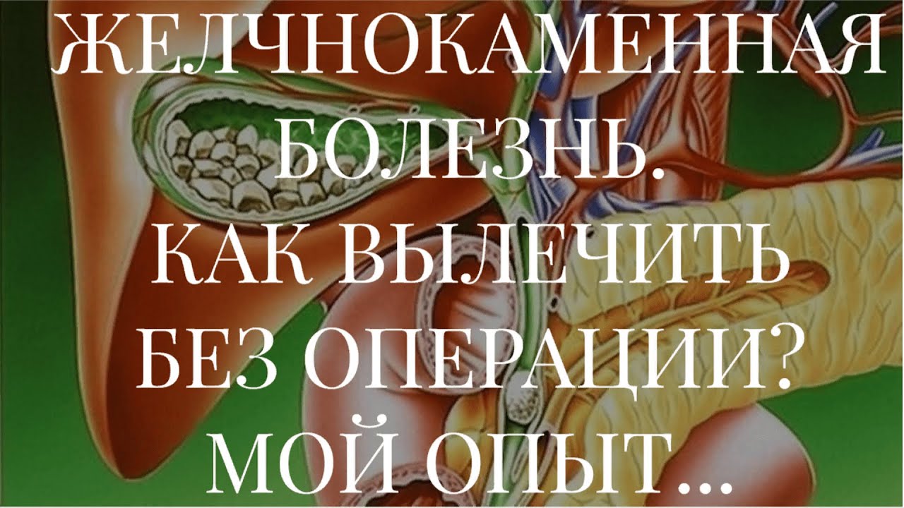 ЖЕЛЧНОКАМЕННАЯ БОЛЕЗНЬ. КАК ВЫЛЕЧИТЬ БЕЗ ОПЕРАЦИИ? МОЙ ОПЫТ... - YouTube
