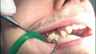 Scaling Gigi Penghapusan Plak