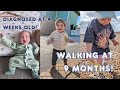 Hip Dysplasia diagnosis 18 months later | Pavlik harness to healthy hips