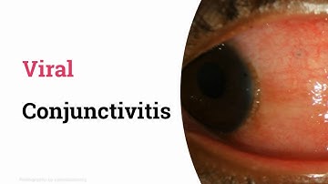 Viral conjunctivitis