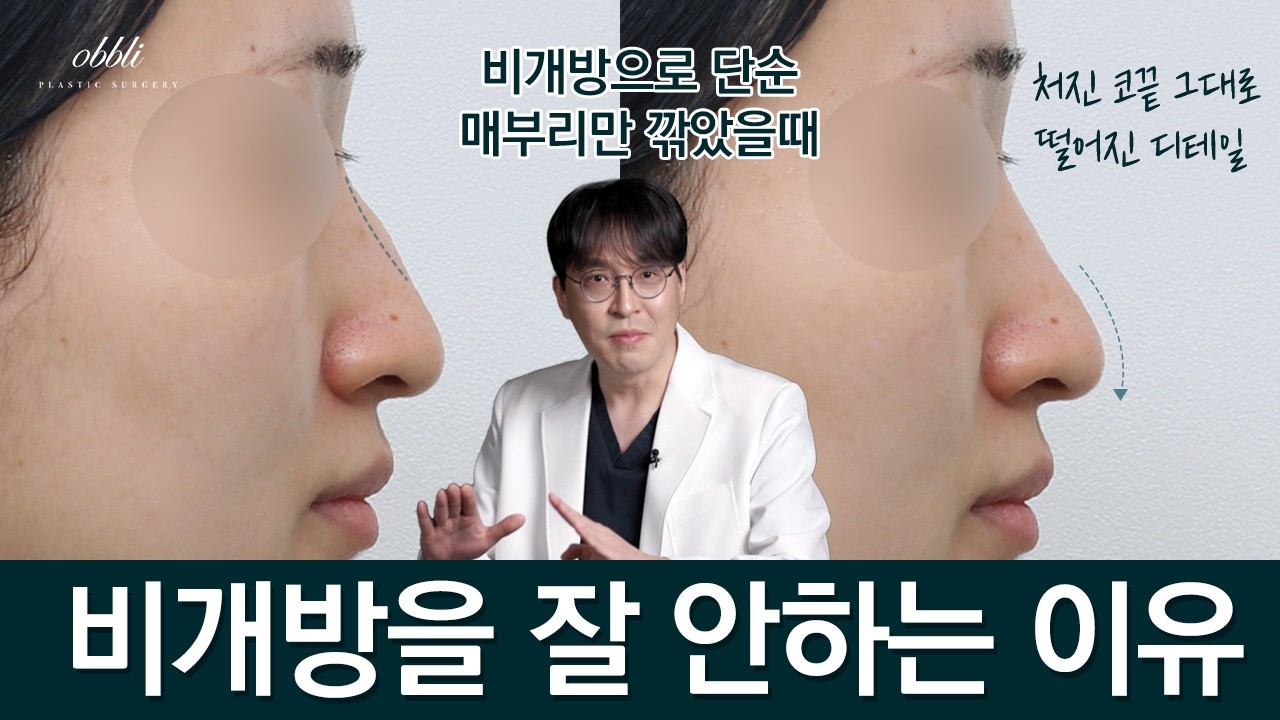 비개방 코성형을 잘 안하는 이유(+개방의 장점)
