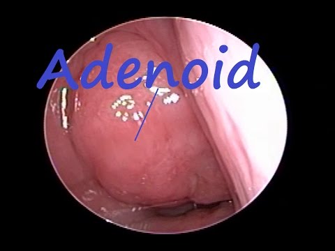 Video: Adenoids In Adults: Symptoms, What They Look Like, Photos, Signs, Treatment