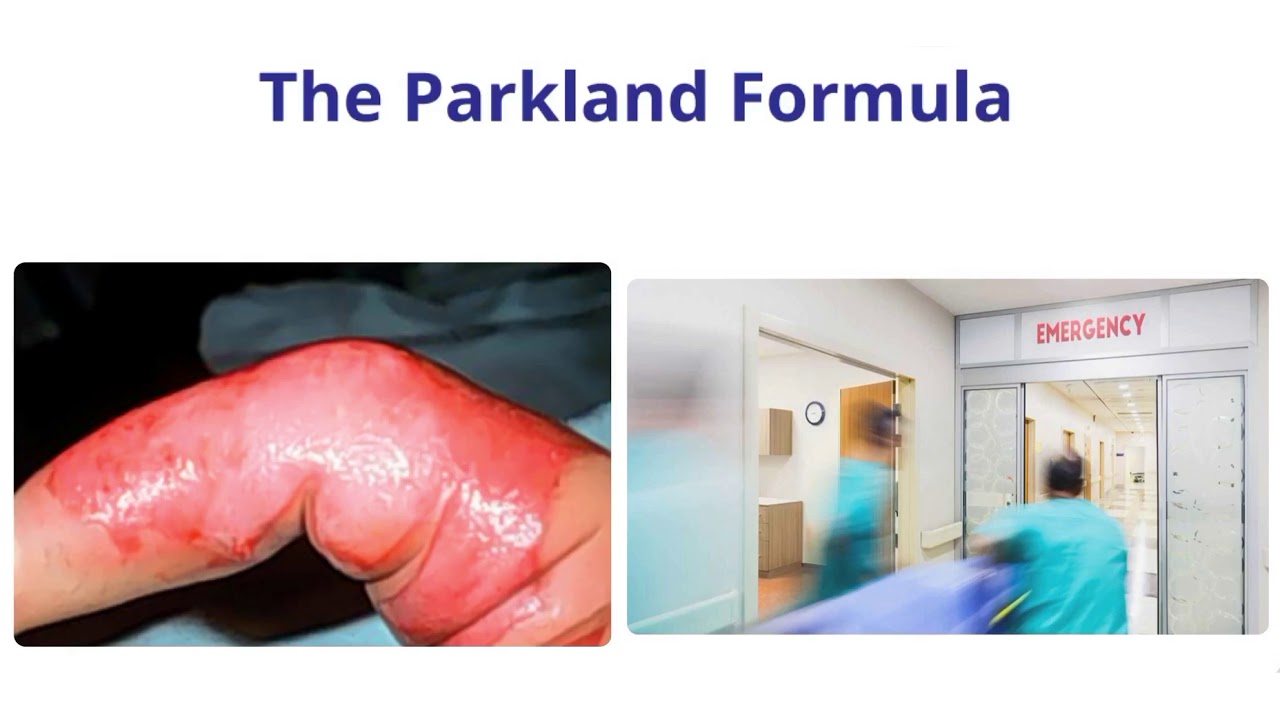 Parkland Formula EXPLAINED and Wallace Rule of Nine in Burns