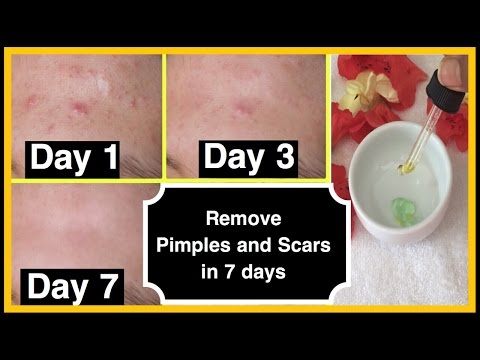 Remove ACNE AND SCARS FAST in  DAYS | DIY ANTI-ACNE SERUM at home | HennaAndNailArt